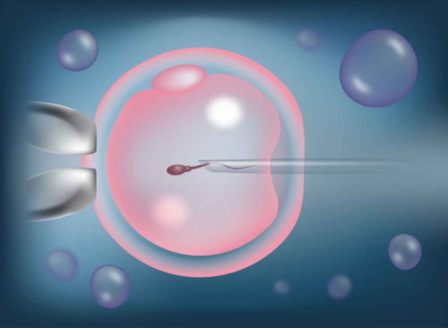 IVF