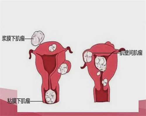 引产术后不孕